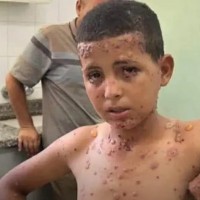 جحيمٌ صحي تحت الحصار: غزة تواجه ”طوفان” الأوبئة والأمراض الجلدية في صيف 2026