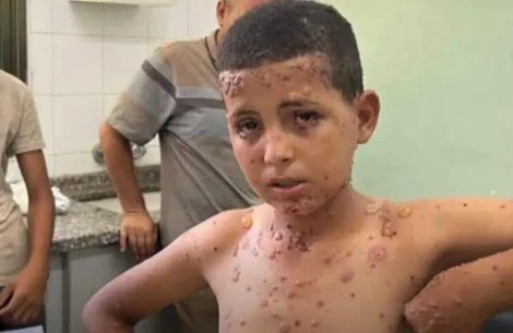 جحيمٌ صحي تحت الحصار: غزة تواجه ”طوفان” الأوبئة والأمراض الجلدية في صيف 2026